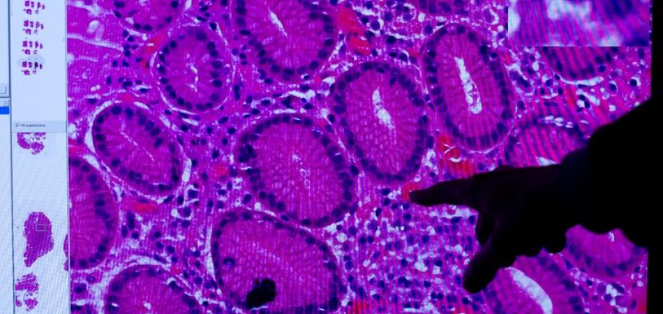 Millones para lucha contra cáncer Millones para lucha contra cáncer